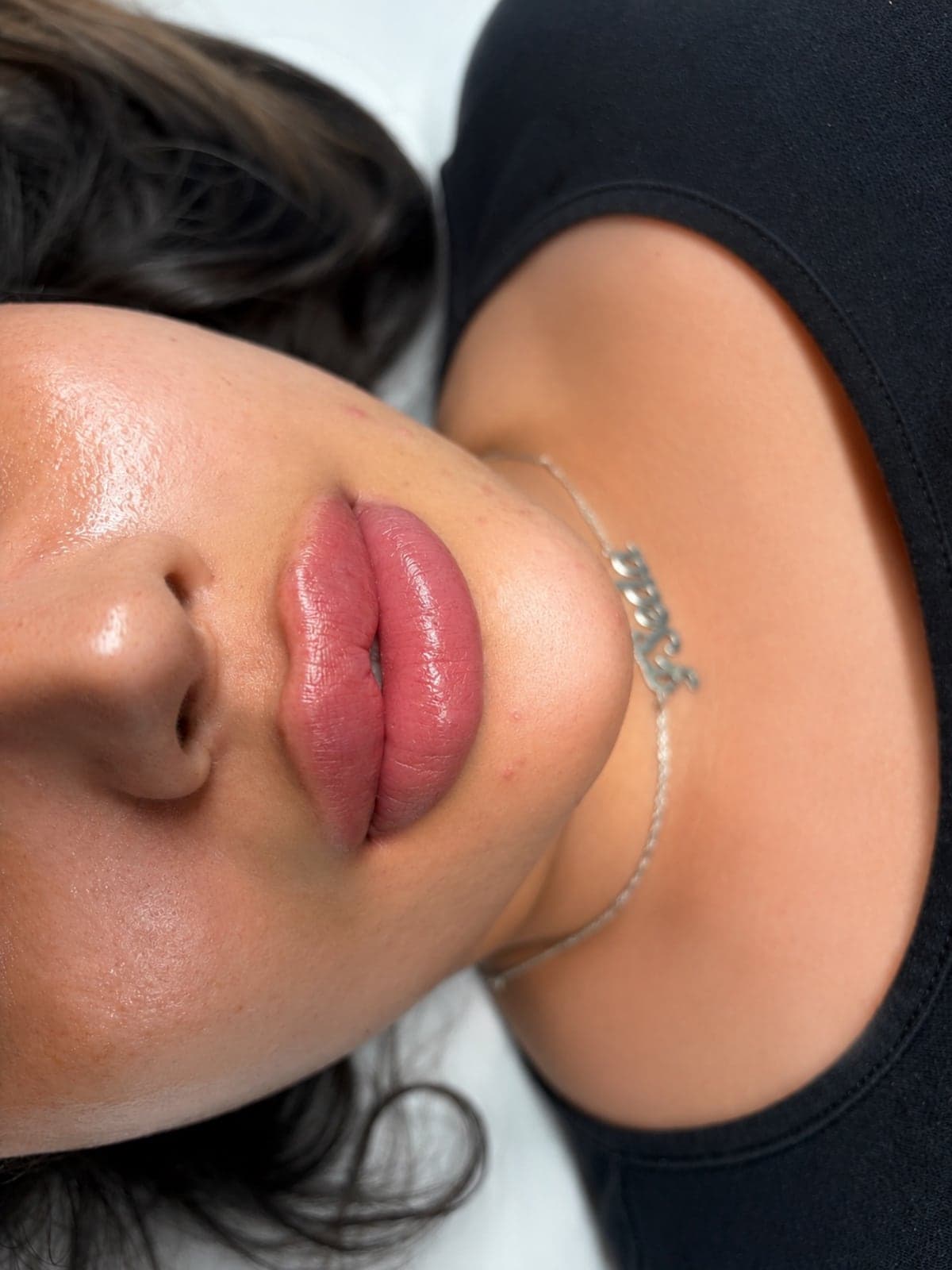 Natural-looking lip filler result at Serra Aesthetics in Walthamstow